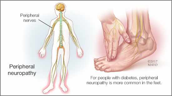 neuropathy-and-chronic-back-pain-painscale